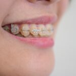 歯科矯正の種類と自分に合った矯正方法の見つけ方